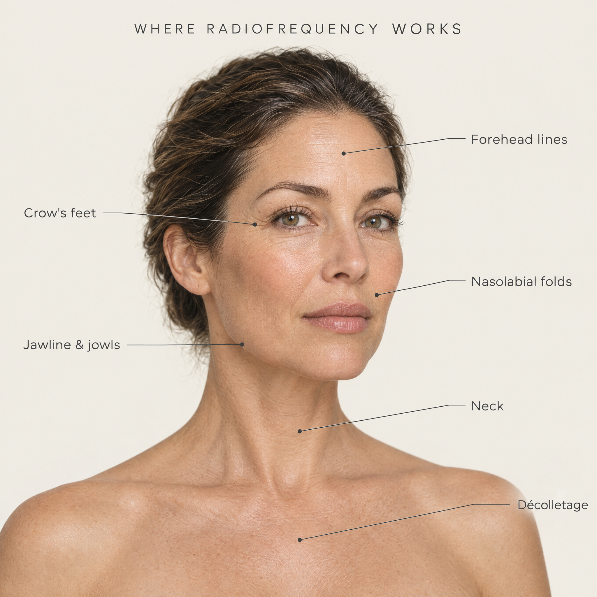 Where radiofrequency works — treatment map