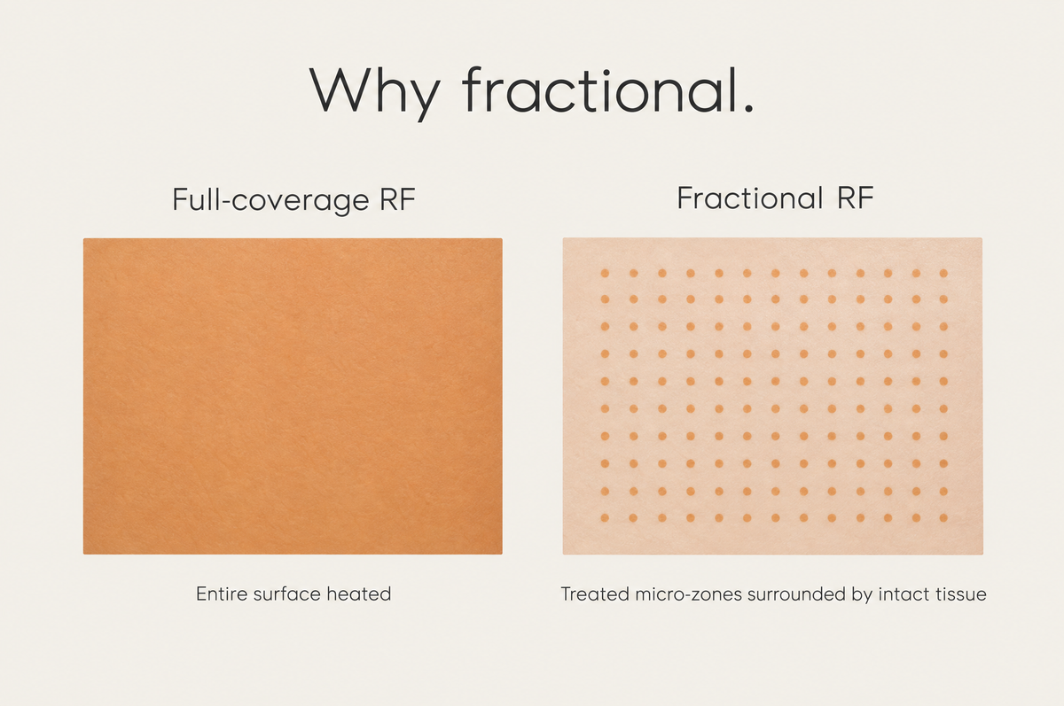 Full-coverage vs fractional RF